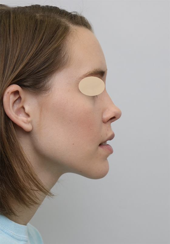 facial implants after 2