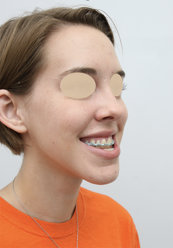 facial implants before 1
