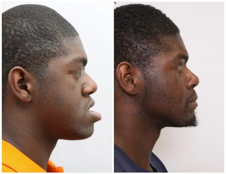 Before and After Facial Surgery Case 9 side