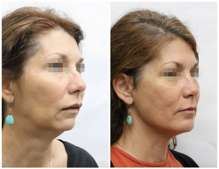 Before and After Facial Surgery Case 10 lat