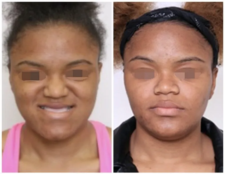 Before and After Facial Surgery Case 2 Front