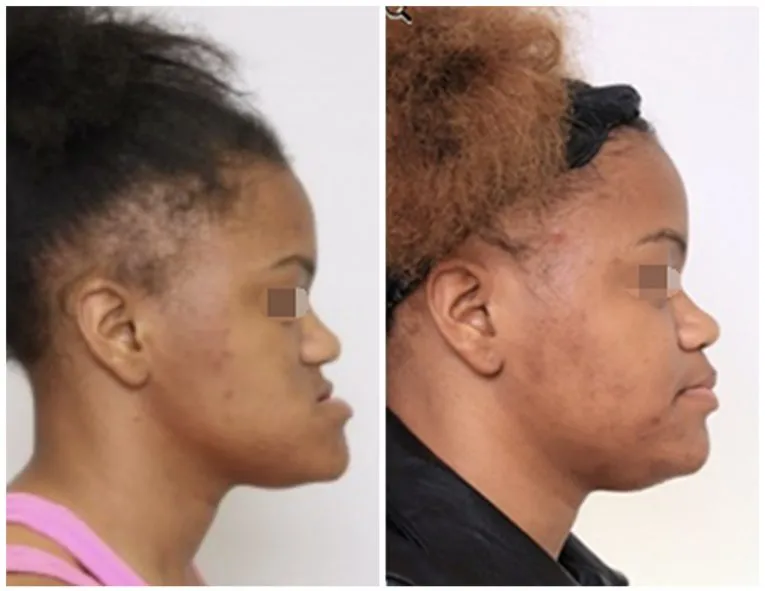 Before and After Facial Surgery Case 2 Side