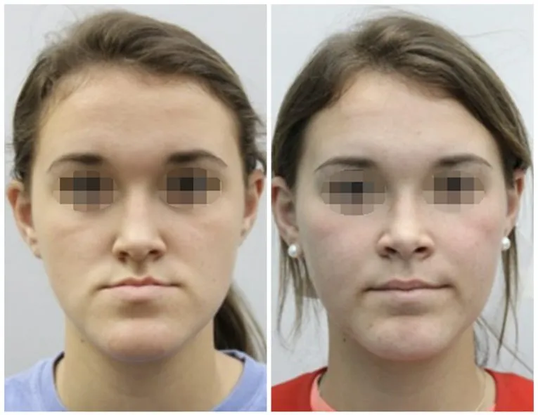 Before and After Facial Surgery Case 3 Front