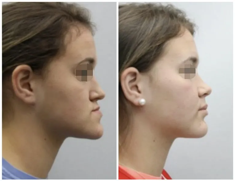 Before and After Facial Surgery Case 3 Side