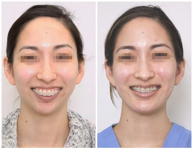 Before and After Facial Surgery Case 4 Front