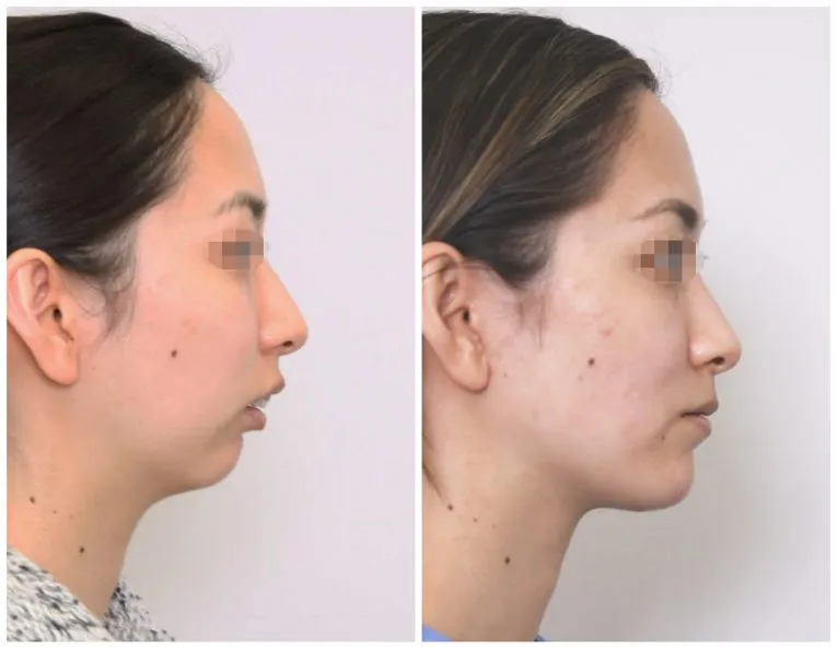 Before and After Facial Surgery Case 4 side