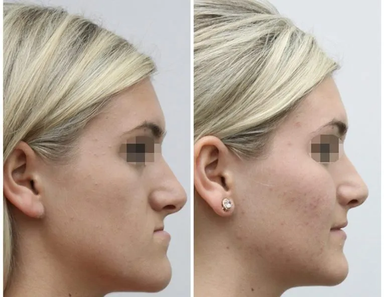 Before and After Facial Surgery Case 5 side