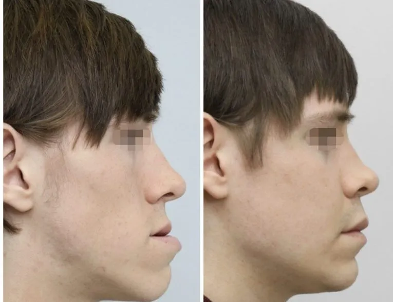 Before and After Facial Surgery Case 6 side