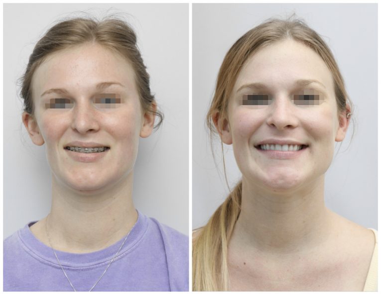 Before and After Facial Surgery Case 7 front