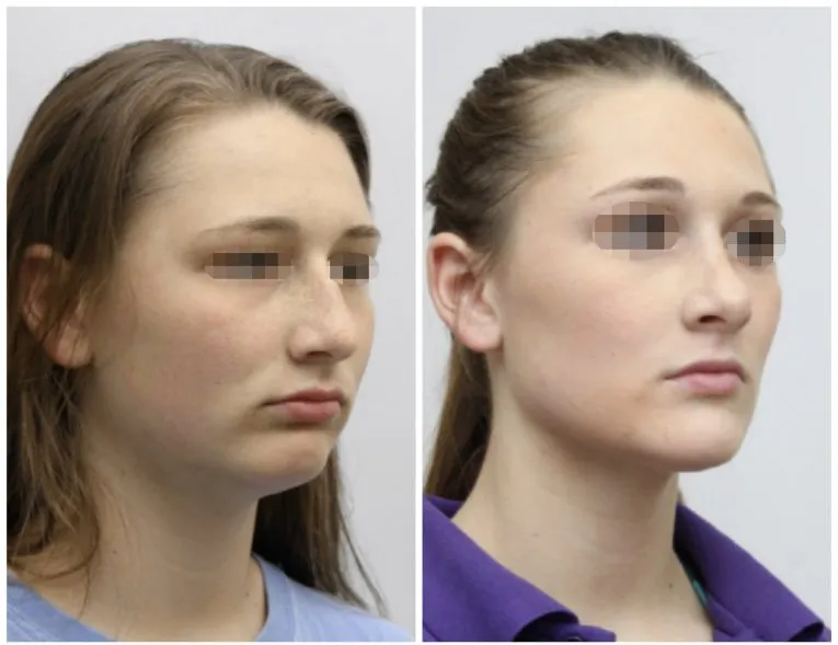 Before and After Facial Surgery Case 8