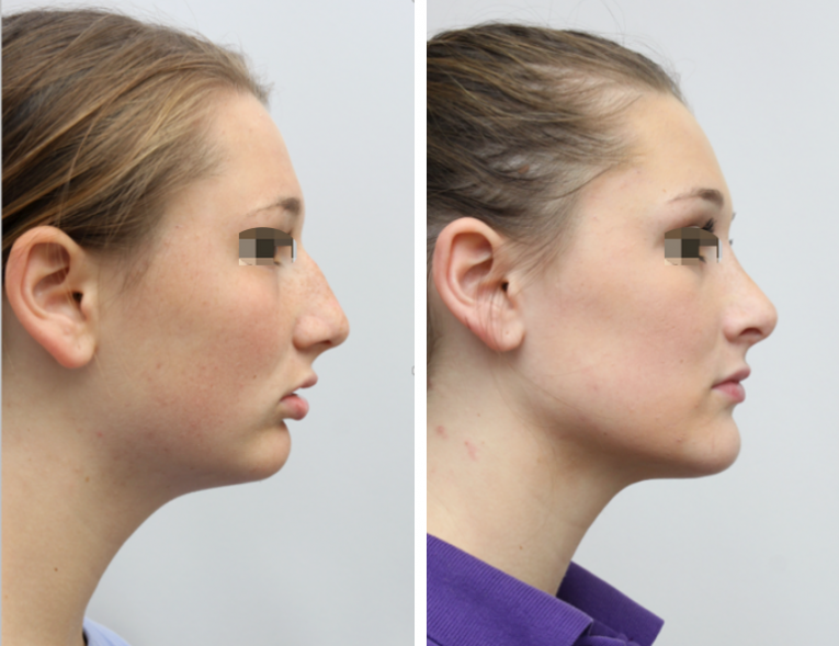 Before and After Facial Surgery Case 8