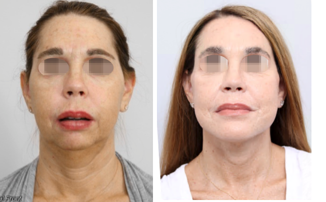 Before and After Facial Surgery Case1 Front
