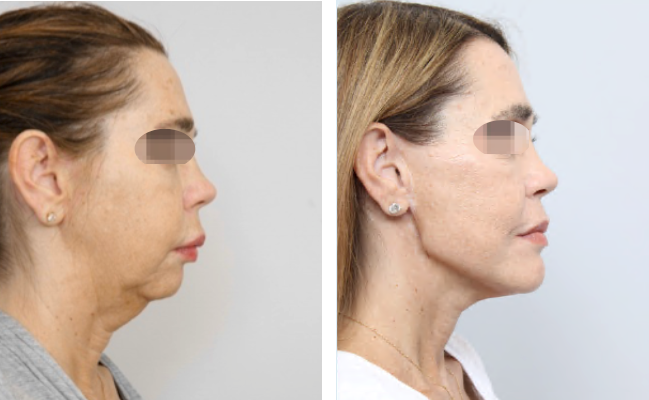 Before and After Facial Surgery Case1 side