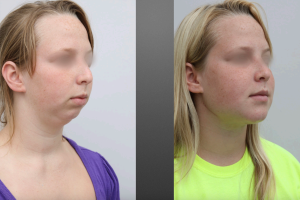 before and after of girl who had upper and lower jaw surgery