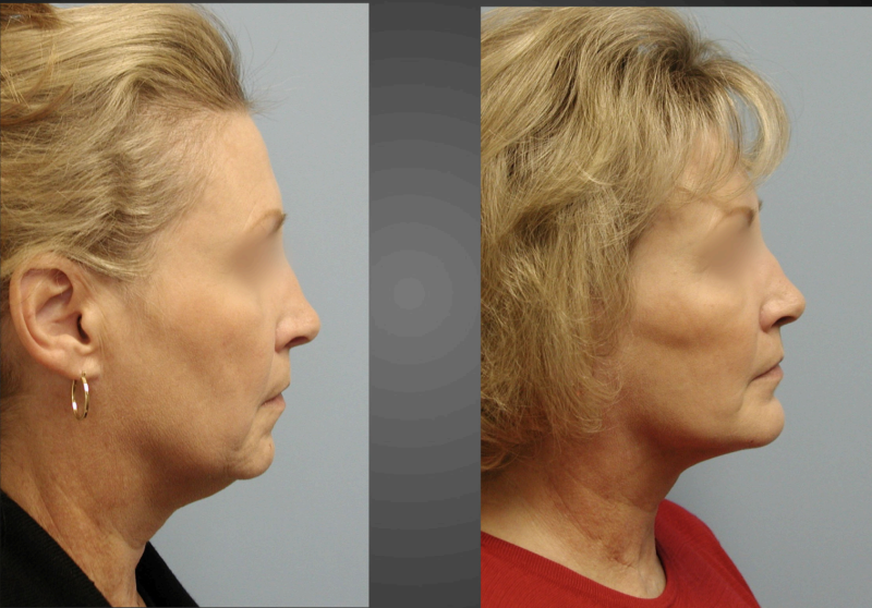 before and after of woman getting chin implants and face lift - profile facing