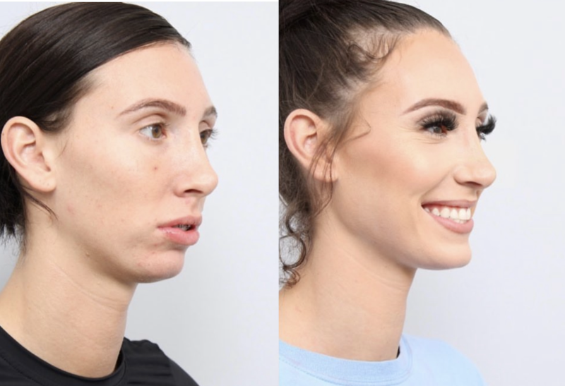 before and after of a woman getting upper and lower jaw advancement surgery - diagonal side profile