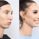 before and after of a woman getting upper and lower jaw advancement surgery - diagonal side profile