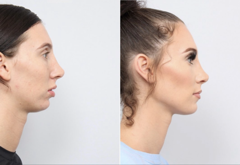 before and after of a woman getting upper and lower jaw advancement surgery - side profile