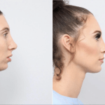 before and after of a woman getting upper and lower jaw advancement surgery - side profile