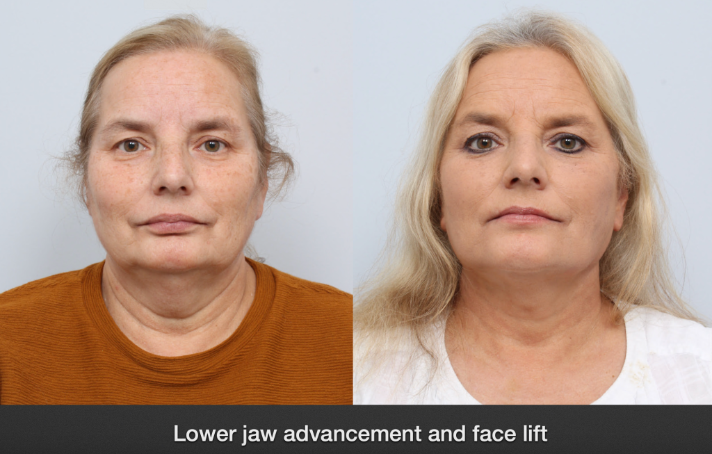 before and after facelift procedure in a woman - front facing