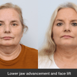before and after facelift procedure in a woman - front facing