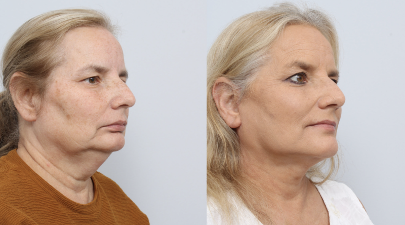 before and after facelift procedure in a woman - diagonal profile