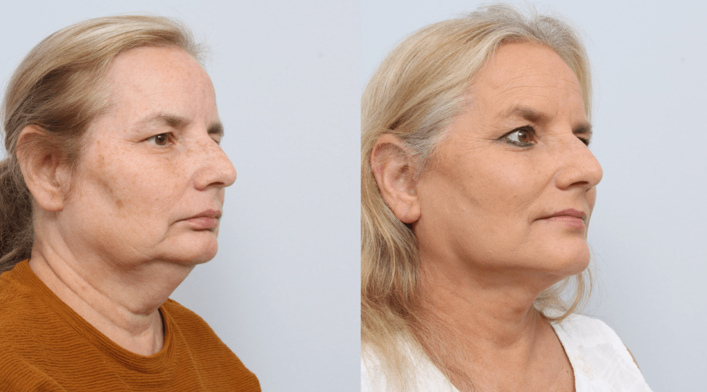 before and after facelift procedure in a woman - diagonal profile