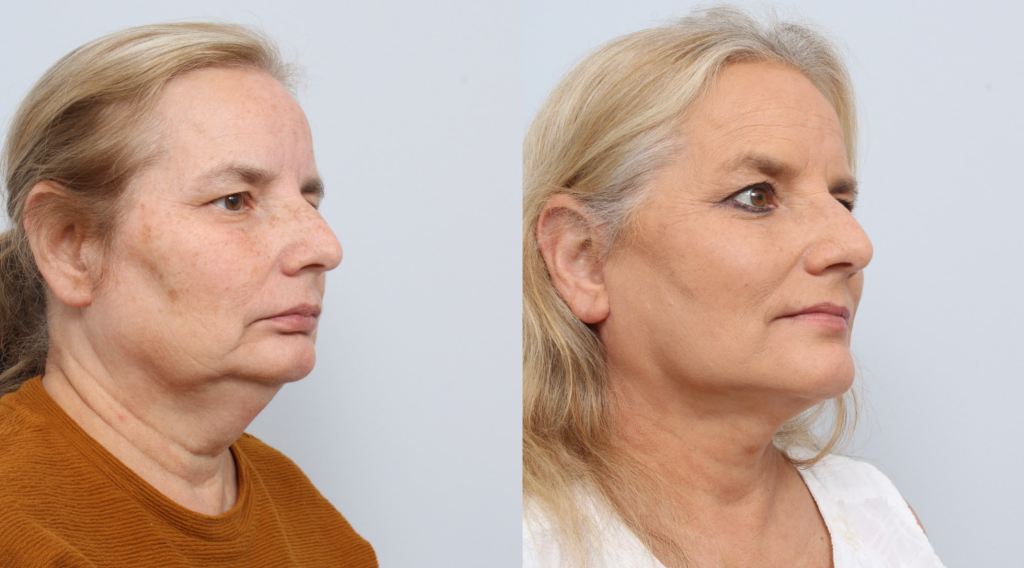 before and after facelift procedure in a woman - diagonal profile