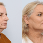 before and after facelift procedure in a woman - diagonal profile