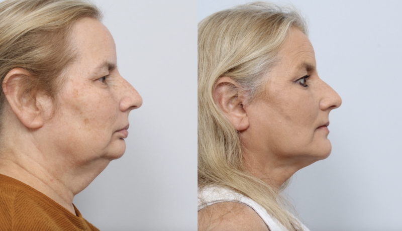 before and after facelift procedure in a woman - side profile
