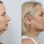 before and after facelift procedure in a woman - side profile