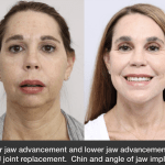 before and after of a woman who got Upper jaw advancement and lower jaw advancement with TMJ joint replacement. Chin and angle of jaw implants - front facing