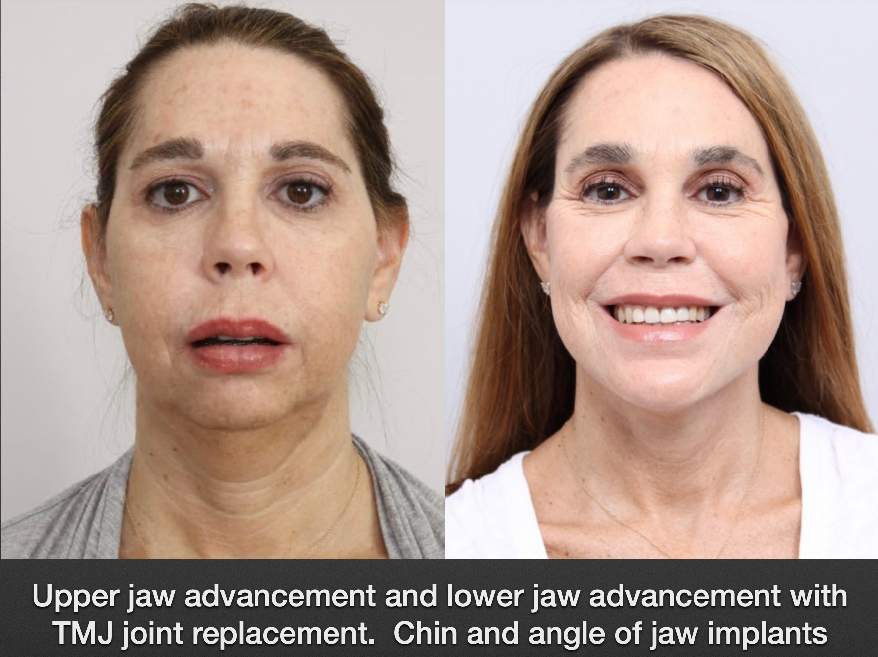 before and after of a woman who got Upper jaw advancement and lower jaw advancement with
TMJ joint replacement. Chin and angle of jaw implants - front facing