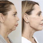 TMJ joint replacement. Chin and angle of jaw implants - side facing