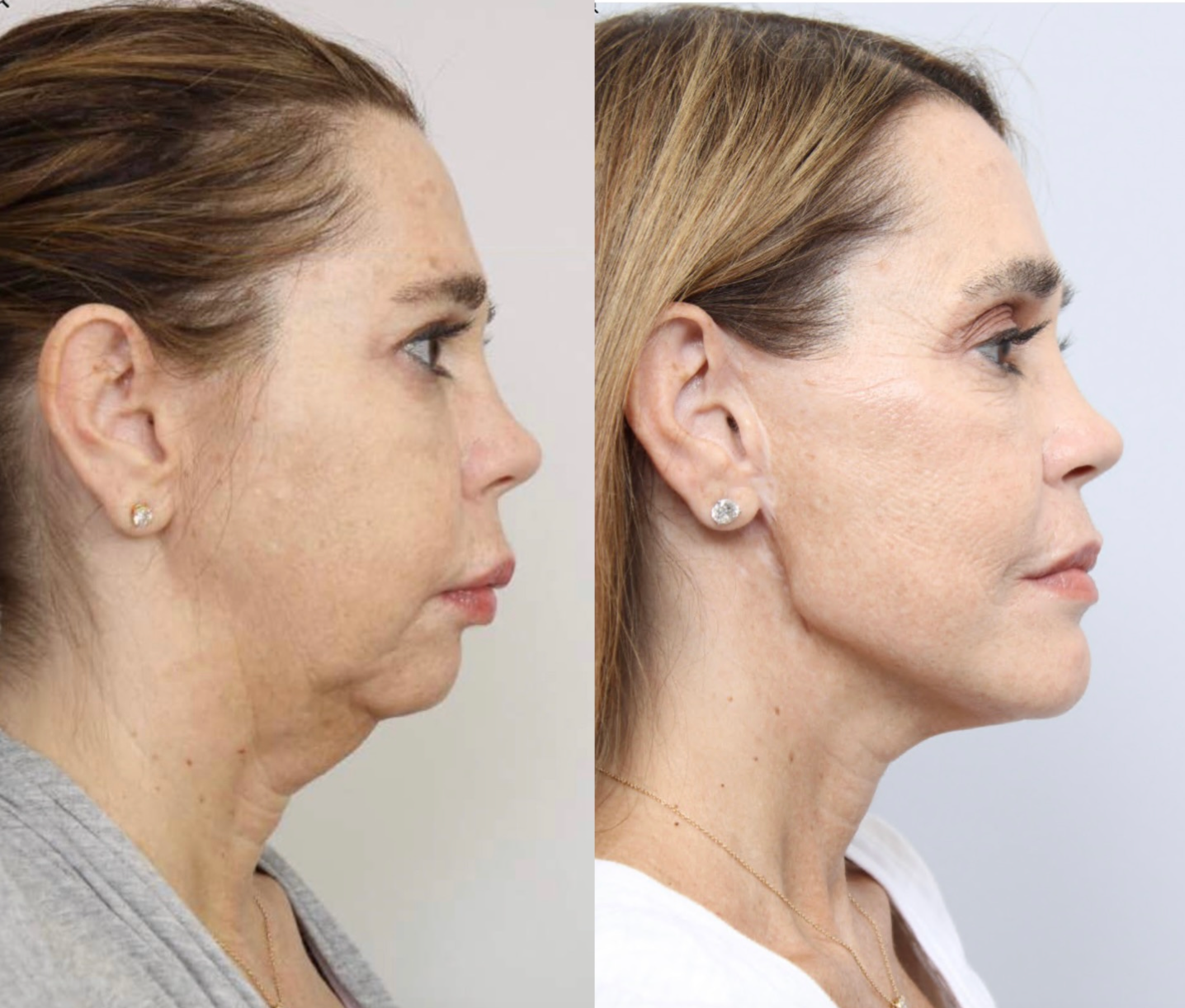 TMJ joint replacement. Chin and angle of jaw implants - side facing