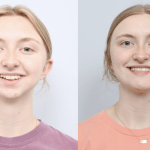 before and after a girl getting upper and lower jaw advancements with a TMJ joint replacement and a chin implant - front facing
