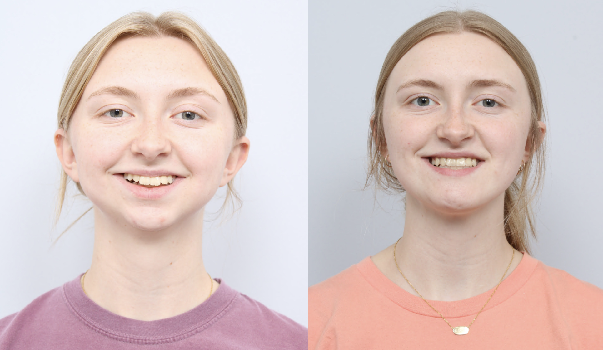 before and after a girl getting upper and lower jaw advancements with a TMJ joint replacement and a chin implant - front facing