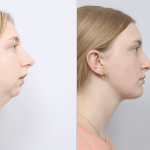 before and after a girl getting upper and lower jaw advancements with a TMJ joint replacement and a chin implant - profile facing