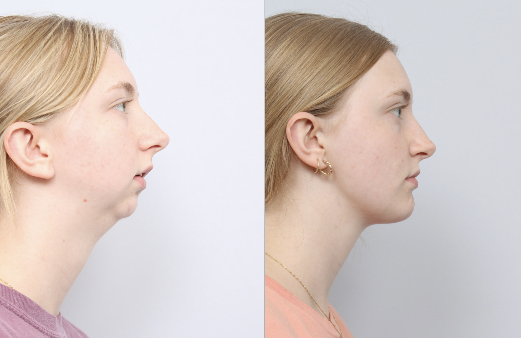 before and after a girl getting upper and lower jaw advancements with a TMJ joint replacement and a chin implant - profile facing