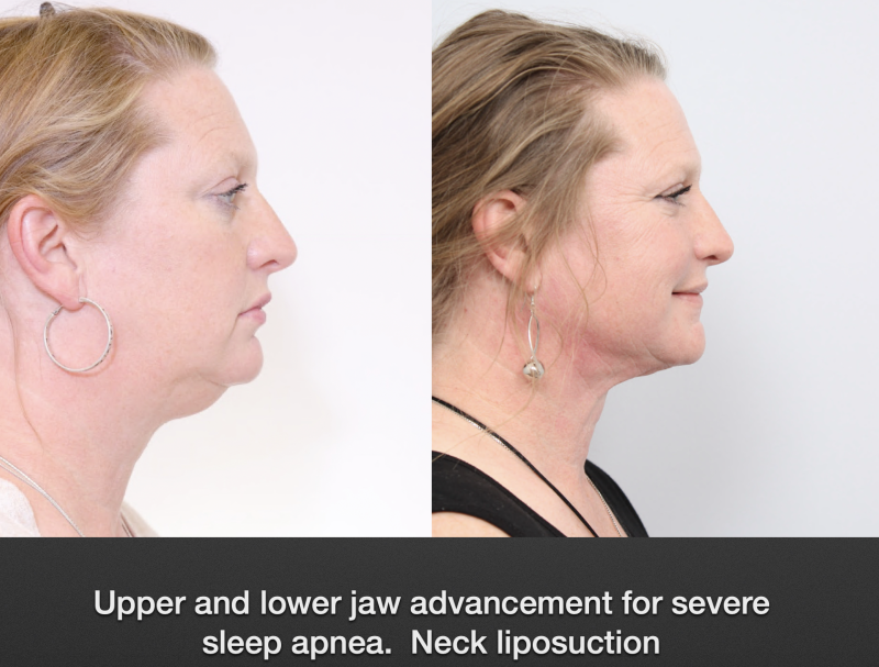 before and after of a woman getting a neck liposuction and sleep apnea treatment - profile facing