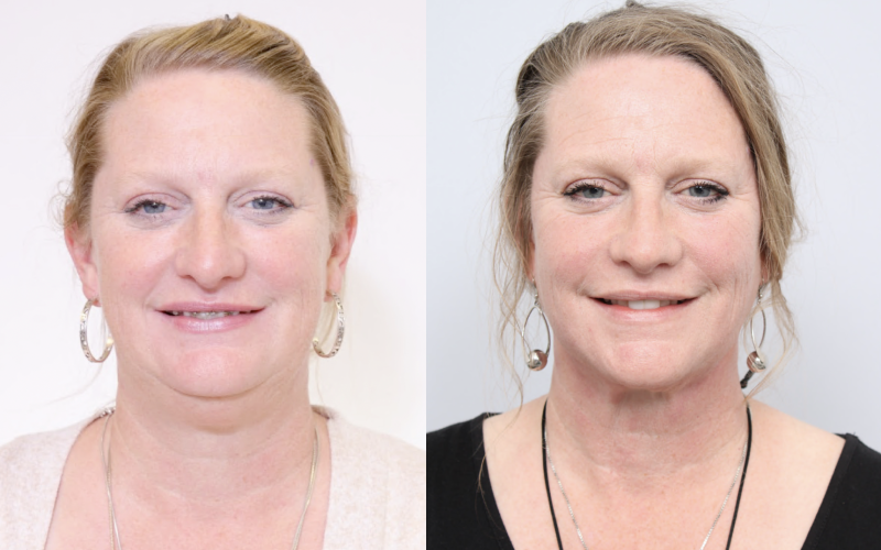 before and after of a woman getting a neck liposuction and sleep apnea treatment - front facing