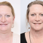 before and after of a woman getting a neck liposuction and sleep apnea treatment - front facing