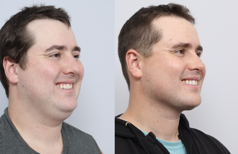 before and after of a man getting a neck liposuction and sleep apnea treatment - diagonal profile