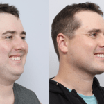 before and after of a man getting a neck liposuction and sleep apnea treatment - diagonal profile