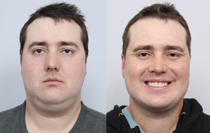 before and after of a man getting a neck liposuction and sleep apnea treatment - front facing