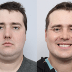 before and after of a man getting a neck liposuction and sleep apnea treatment - front facing