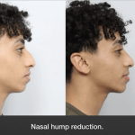 before and after boy getting a nasal hump reduction - side profile