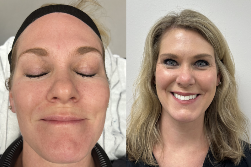 helix face skin resurfacing procedure in a woman before and after - profile