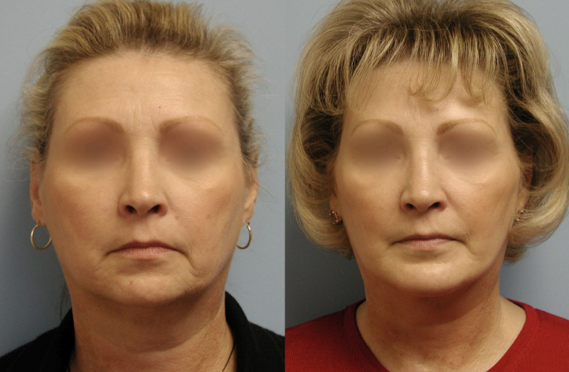 before and after image of women getting chin implants and facelift - front facing