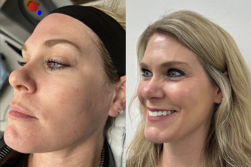 helix skin resurfacing procedure before and after in a woman -side profile